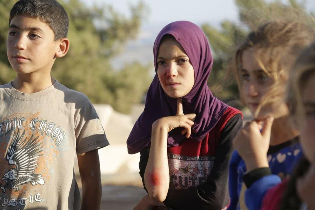 انتشار مرض “القوباء” في مخيم الدويلة للنازحين بالقرب من سلقين بريف إدلب